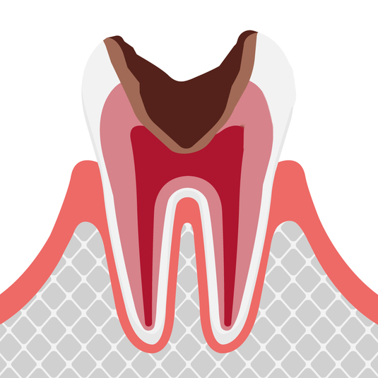 歯髄＝歯の神経まで達したむし歯
