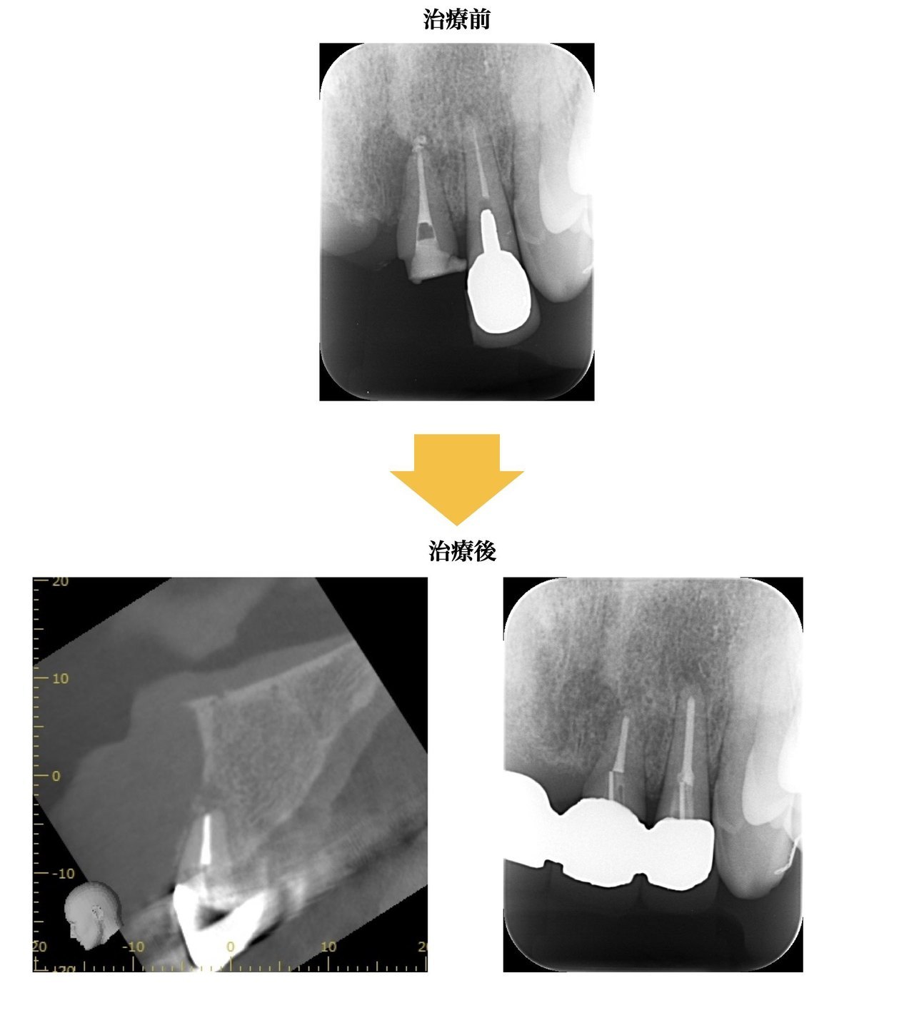 歯根端切除術・再生治療症例